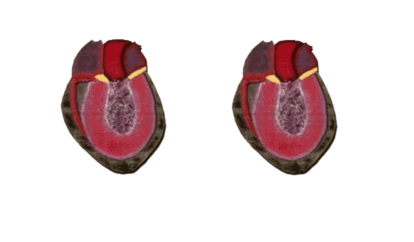 krankes_herz Blutvolumenregulation